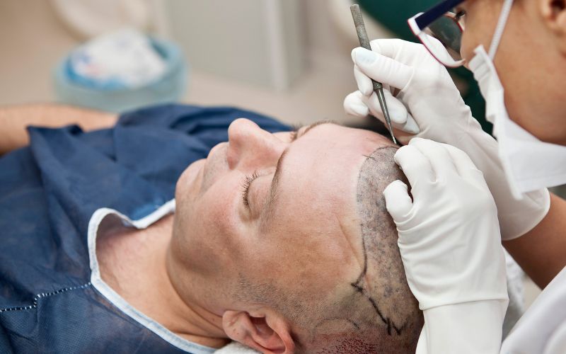 Comparing FUT and FUE Hair Transplant Procedures