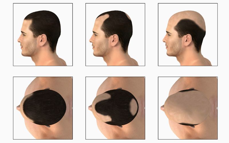 Understanding Hair Loss: Causes and Solutions